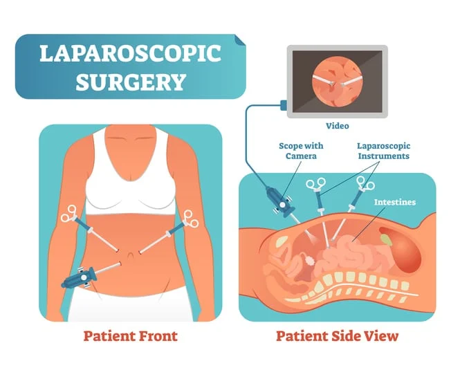 Laparoscopy